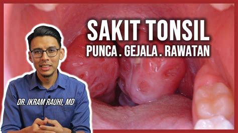 Sakit Tonsil Acute Tonsillitis Rawatan Dan Cara Hilangkan Sakit