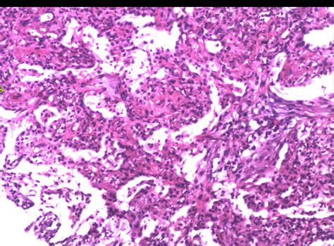 Chronic Eosinophilic Pneumonia A Case Report And Review Of The Literature