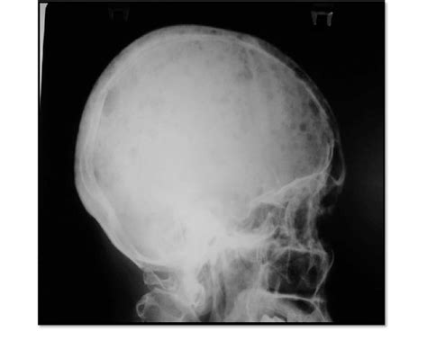 Skull X Ray Lateral View Showing Osteolytic Lesion Download