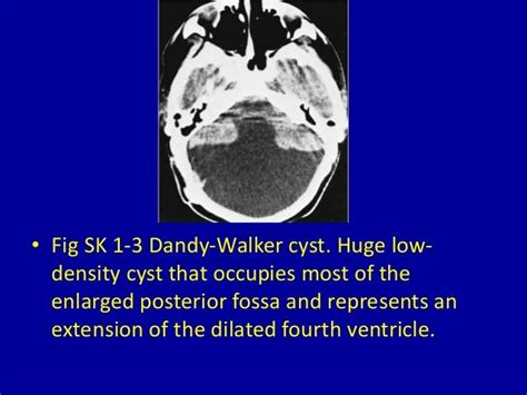 1 Dilated Cerebral Ventricles Radiology