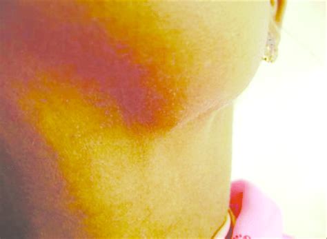 A 34 Year Old Female Patient With A Swelling On The Left Side Of The