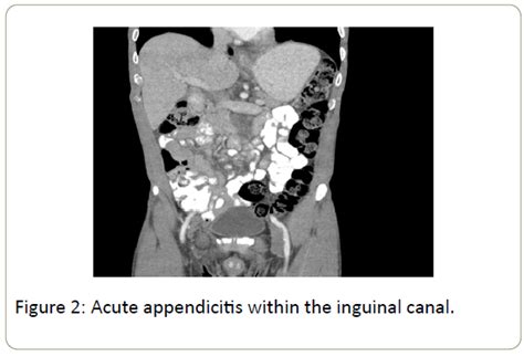Acute Tip Appendicitis Contained Within A Right Sided Inguinal Hernia