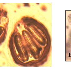 (PDF) Human Extensive Head Skin Myiasis