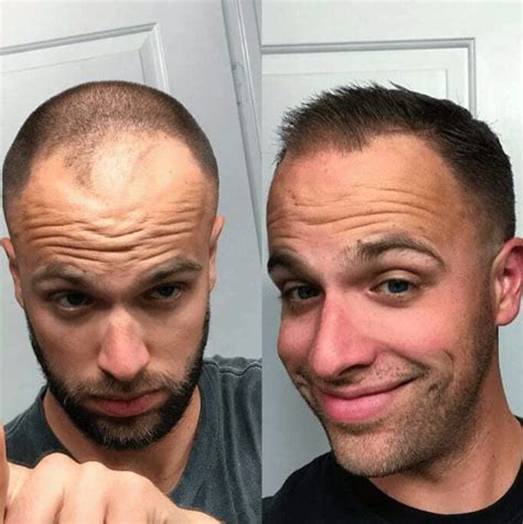 Hims Uk Review Does It Work For Mens Hair Loss Fin Vs Fin