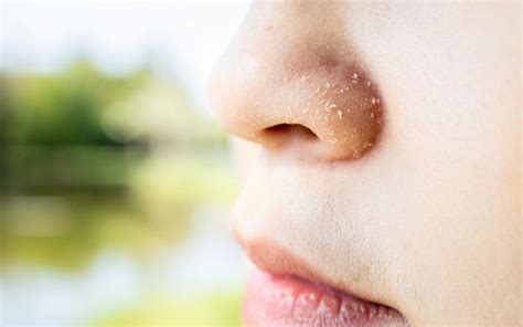 We did not find results for: Dry Skin Around The Nose: 8 Causes, 9 Treatments ...
