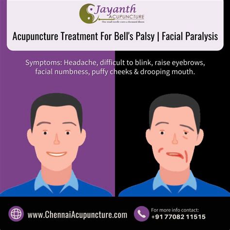 Acupuncture Treatment For Bells Palsy Facial Paralysis Chennaibest