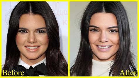 Kendall Jenner Before And After Plastic Surgery Leaked Photos Youtube