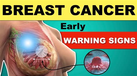What Are The Warning Signs Of Breast Cancer Early Sign Of Breast My