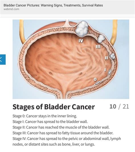 Metastasis to the pelvic bone and/or lumbar spine is likely. Pin on Health & Beauty