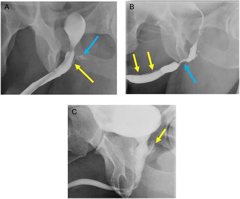 Anterior Urethral Strictures And Retrograde Urethrography An Update For Radiologists Clinical