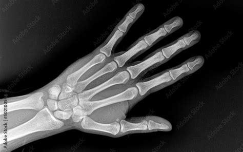 Xray Of Human Hand Fingers Top View X Ray Of Male Hand And Wrist X