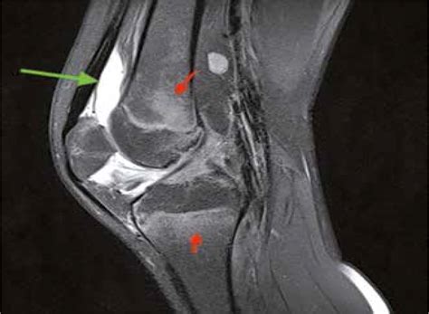 Magnetic Resonance Imaging Of The Knee Joint In Juvenile Idiopathic Arthritis