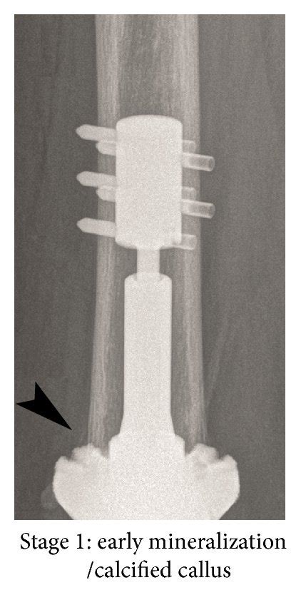 Radiographic Stages Of Osseointegration According To The New Assessment