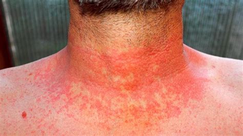 Autoimmune Skin Diseases And Rashes That Affect Appearance Everyday