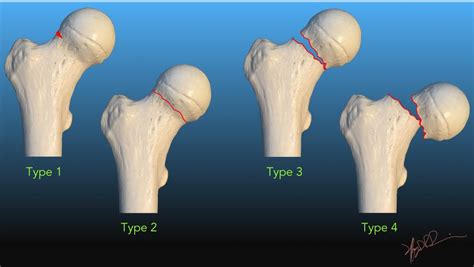 Garden Classification of Femoral Neck Fractures | UW ...