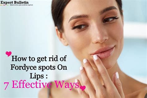 How To Get Rid Of Fordyce Spots On Lips 7 Effective Ways Fordyce