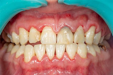 The Different Stages Of Periodontal Disease Sumner Wa