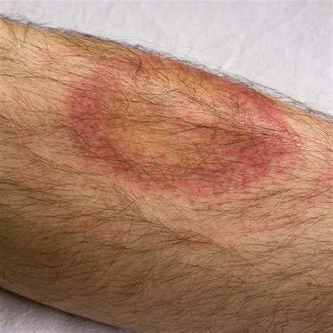 Ticks And Lyme Disease Johns Hopkins Medicine
