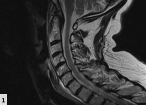 Figure 1 Cervical Spine Mri Reveals Diffuse Bone Lytic Lesions In The