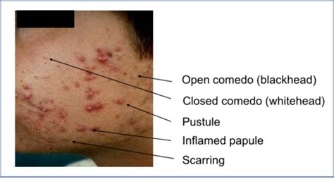 11.28.17 Acne Vulgaris Flashcards | Quizlet