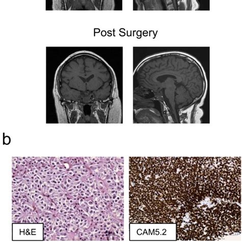Sellar Mri And Pathology Of The Corticotroph Tumor Of Case 1 A Mri