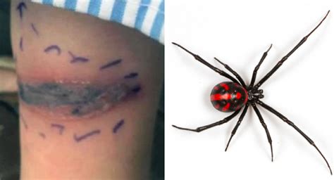 False Black Widow Bite Treatment How To Spot False Widow Spiders