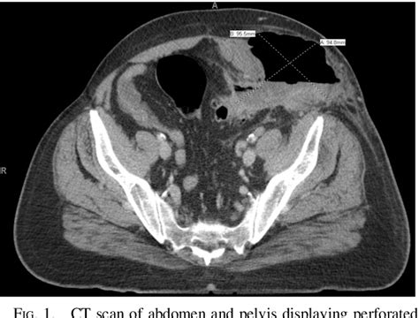 Figure 1 From Perforated Sigmoid Diverticulitis Resulting In