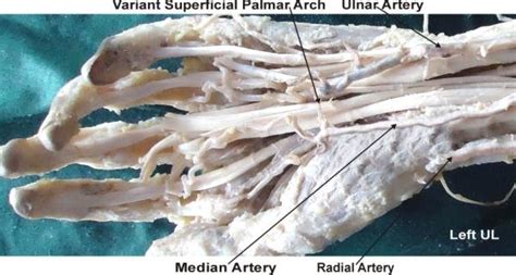 The Variant Superficial Palmar Arch Formed By The Ulnar Artery And The