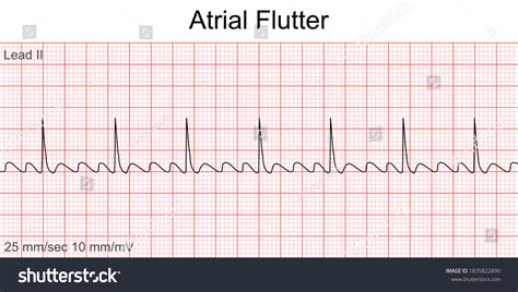 Atrial Flutter Ekg Ecg Interpretation Youtube Vrogue Co