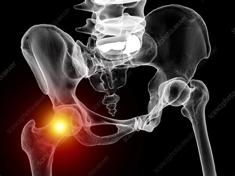Hip Joint Pain Conceptual Illustration Stock Image F0376929