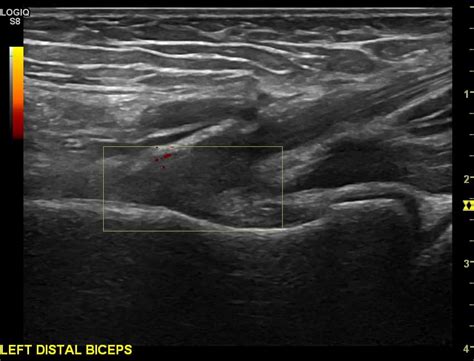 Distal Biceps Rupture Ultrasound