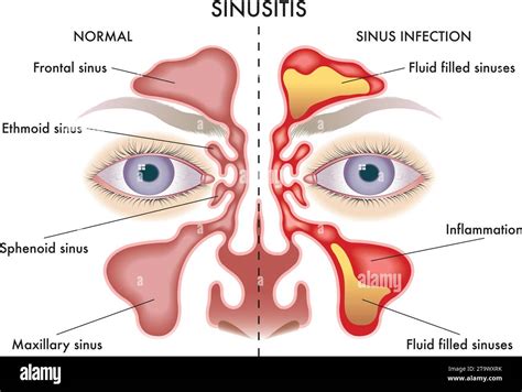 Medical Illustration Of Symptoms Of Sinusitis Stock Vector Image And Art