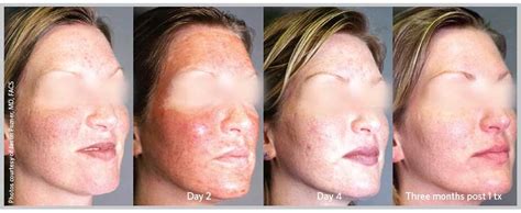Laser Peels Superficial Skin Resurfacing Healing