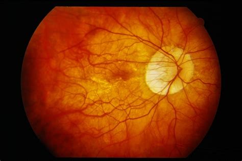 Peripapillary Atrophy With High Myopia Retina Image Bank