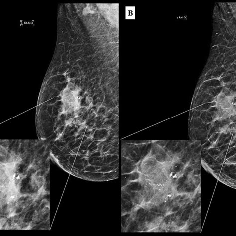 A 80 Year Old Female Who Presented With A Palpable Lump In The Left