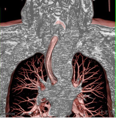 Thyroid Goiter Displaces The Trachea In 3d Chest Case Studies