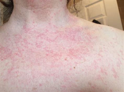 Images Show Eight Types Of Rash That Could Be Symptom Of