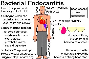 It may be acute or chronic and can occur at any age. Top Dentists Online - Bacterial Endocarditis | Pediatric ...