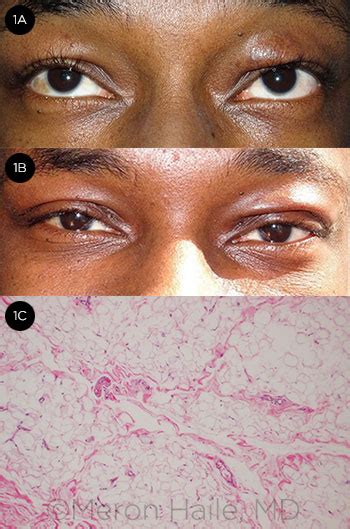 Blepharochalasis Syndrome American Academy Of Ophthalmology