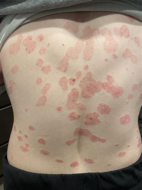 Help 5 Month Old Mystery Rash Info Im Comments Rmedicaladvice