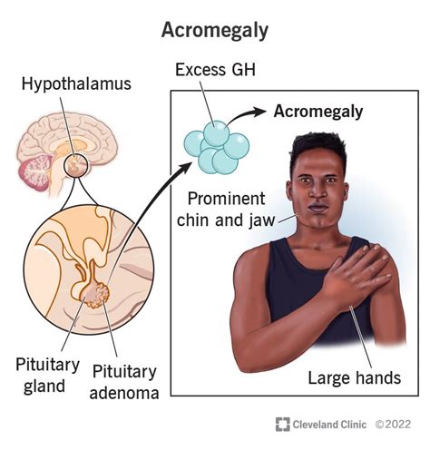 Acromegaly What It Is Causes Symptoms And Treatment