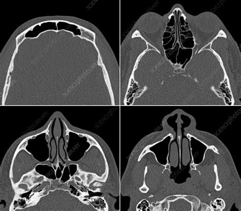 Normal Sinuses Ct Scan Stock Image C0294634 Science Photo Library