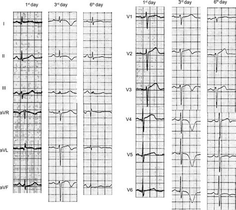 Representative T Wave Changes Of 12 Lead Ecg In A Patient With Tc On