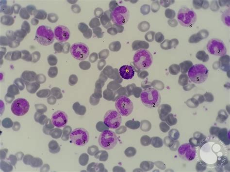 Chronic Myeloid Leukemia Presentation In Peripheral Blood 1