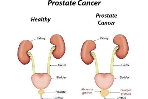 About 1 in 9 men will be diagnosed with prostate cancer in his lifetime. Light therapy and prostate cancer - What do you know about it?