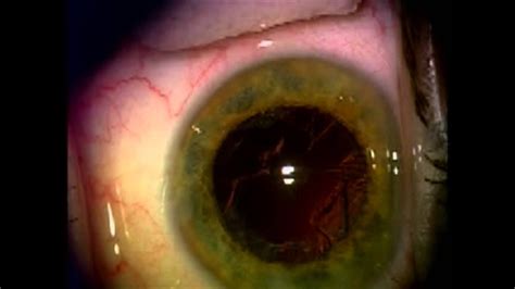 Intraocular Lenses For Cataract Surgery
