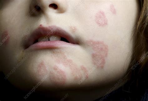 Face Paint Allergy Rash Stock Image C0215598 Science Photo Library