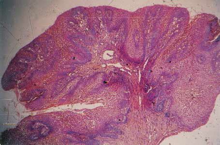 Peripheral Ameloblastoma There Is Typical Ameloblastic Epithelium