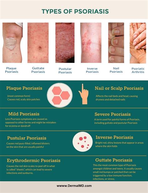 Shop Dermalmd® Psoriasis Treatment Skin Psoriasis Types Of Psoriasis