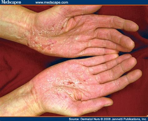 Hand Dermatitis Clinical Features Diagnosis And Management